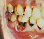      cavities.jpg