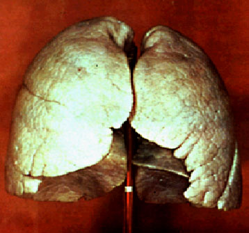      normal_lung.jpg