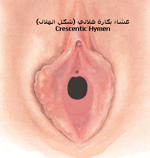[تصویر:  crescentic_hymen.jpg]