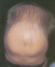 Androgenic alopecia-male pattern baldness