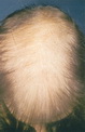 Androgenic alopecia-female