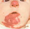 Capillary haemangioma of infancy