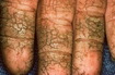 Contact Dermatitis-Chronic