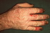 Contact Dermatitis-Chronic-Occupational