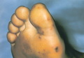 Infective endocarditis-feet