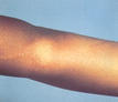 Leprosy-Tuberculoid