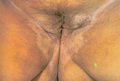 Lichen sclerosus et atrophicus-vulva