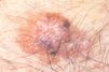 Melanoma arising from a congenital nevomelanocytic nevus