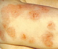 Nummular dermatitis