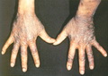 Pellagra-hands
