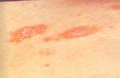 Pityriasis rosea-marginal collarette scales