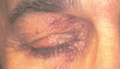 Primary systemic amyloidosis-papules around the eye