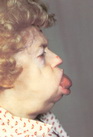 Primary systemic amyloidosis-macroglossia