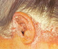 Psoriasis-scalp