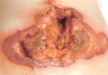 Pyoderma gangernosum-ulcer