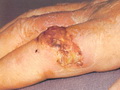 Squamous cell carcinoma-ulceration