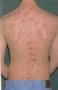 Acne extensive-Back
