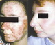 Acne-before and after treatment with isotretinoin