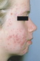 Acne-greasy skin with papules
