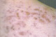 Acne-skin pigmentation due to Minocycline
