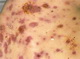 Acne-nodular - atrophic scars