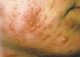 Acne- papules and pustules - face