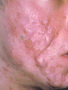 Acne - severe case