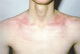 Acne- eryhtroderma due to local tretinoin