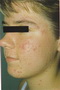 Acne mild case