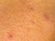 Acne-whiteheads with papules