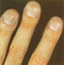 Clubbed fingers