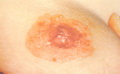 Paget's disease-nipple