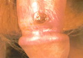 Penile primary chancre-syphilis