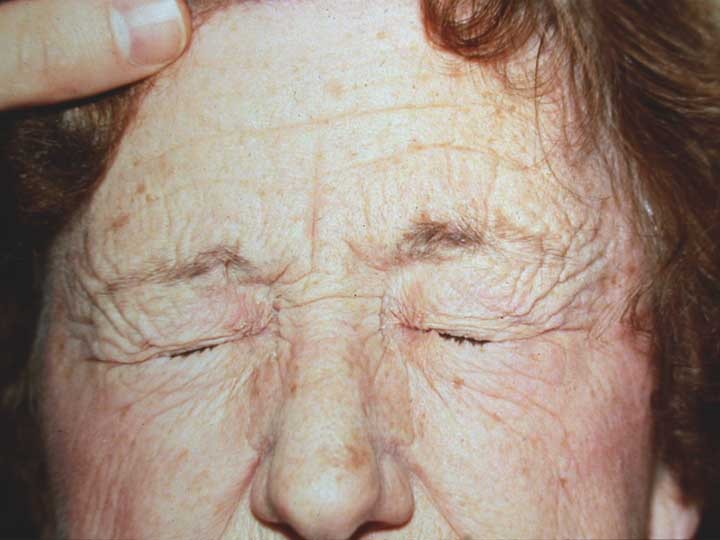 تشنجات الوجه و الجفون و علاجها بالبوتکس,أنواع تشنجات الوجه والجفون